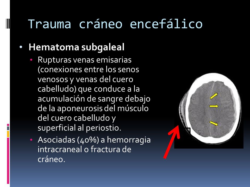 Imágenes del hematoma del cuero cabelludo